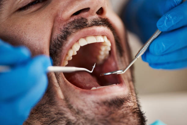 Best Emergency Tooth Extraction in Tton, IL