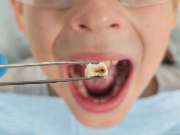 Best Emergency Root Canal Treatment in Tton, IL